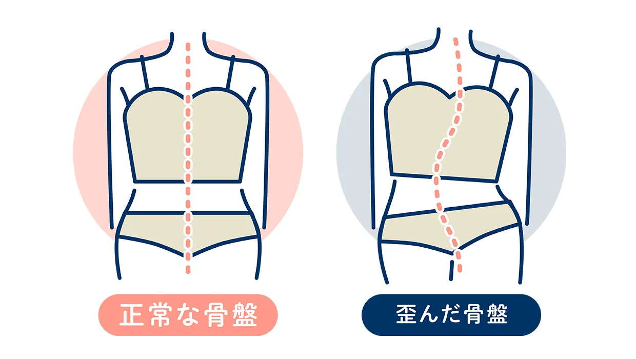 骨盤の歪み